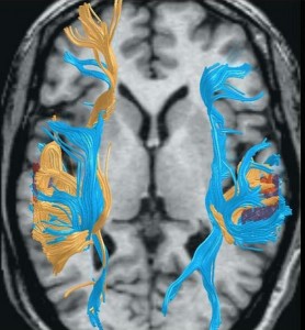 DTI Brain Scan